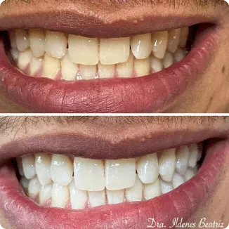 Antes e depois de clareamento dental — caso da Delicare, em Betim