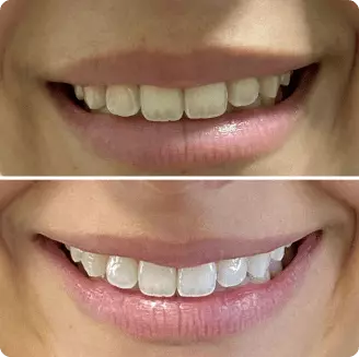 Antes e depois de clareamento dental de consultório — Delicare Odontologia