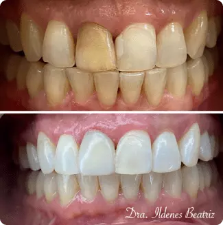 Antes e depois de clareamento dental e facetas em resina — Delicare, Betim