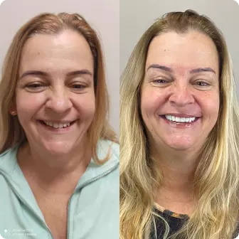 Antes e depois de facetas de porcelana e prótese sobre implante — Delicare, Betim