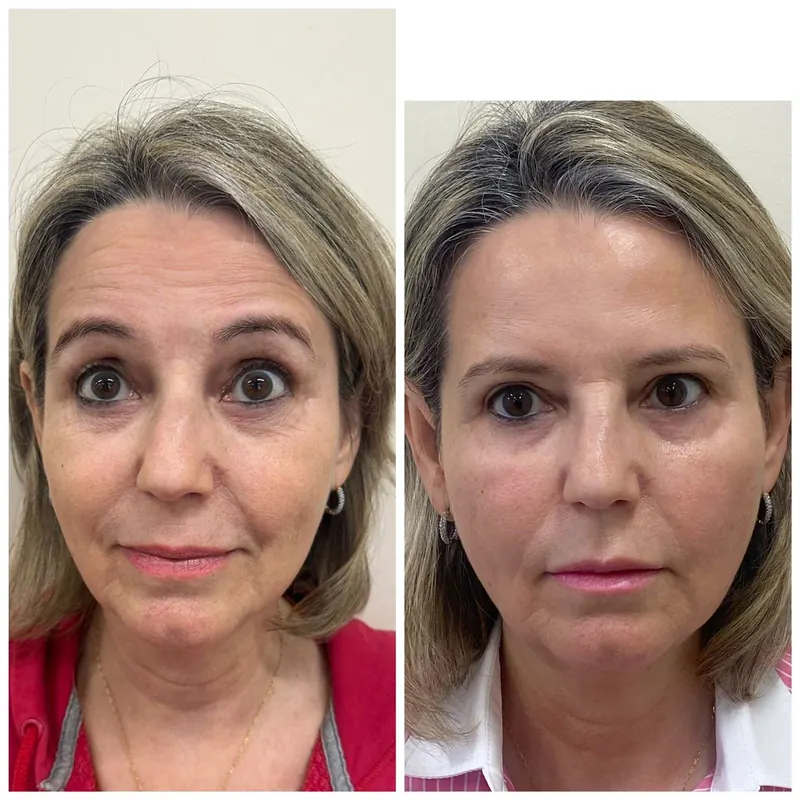 Antes e depois de harmonização facial, vista frontal — paciente atendida na Delicare, em Betim