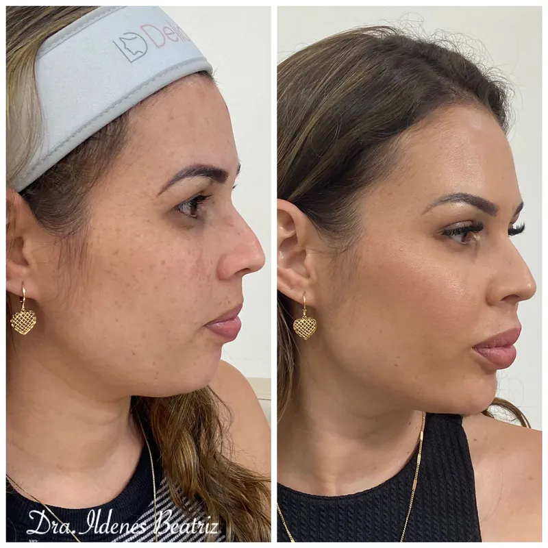 Antes e depois de harmonização facial, vista de perfil — Delicare Odontologia e Estética Orofacial