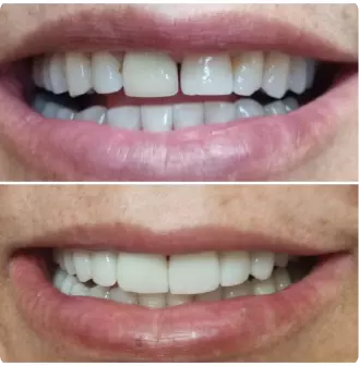 Antes e depois de lentes de contato dental em porcelana — Delicare Odontologia