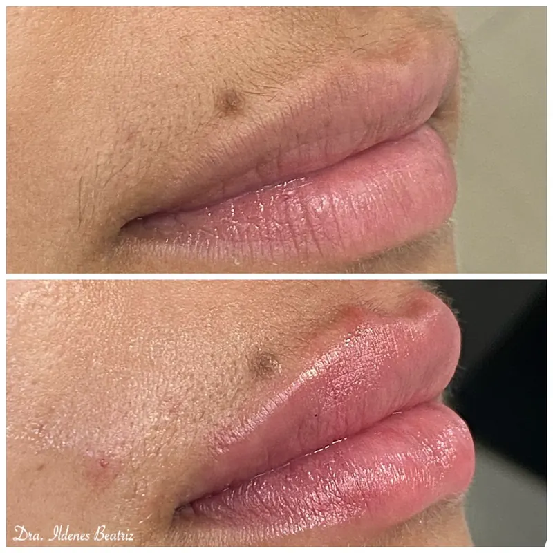 Antes e depois de preenchimento labial realizado na Delicare, em Betim