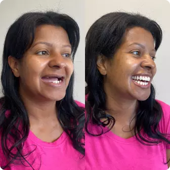 Antes e depois de prótese dentária — caso da Delicare, em Betim
