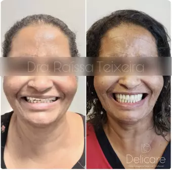 Antes e depois de reabilitação com prótese dentária — Delicare Odontologia
