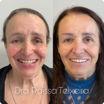 Antes e depois de prótese fixa — caso clínico Delicare, Betim