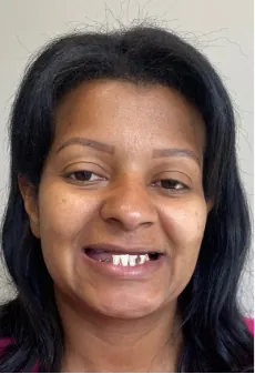 Antes: sorriso com dentes ausentes, antes do tratamento com implantes dentários na Delicare
