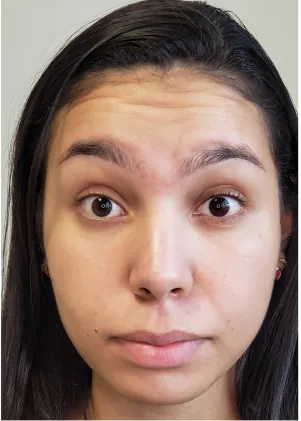 Caso de harmonização facial na Delicare, em Betim — registro 1