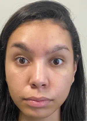 Caso de harmonização facial na Delicare, em Betim — registro 2
