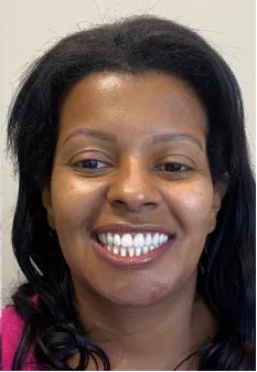 Depois: sorriso reabilitado com implantes dentários na Delicare, em Betim